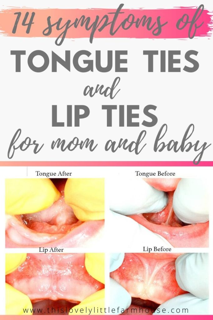 Learn the 14 most definite signs of a baby with a tongue and lip tie. We’ll discuss both tongue tie symptoms and lip tie symptoms and how they affect breastfeeding for both mama and baby from low milk supply to frequent mastitis and excessive gas. #tonguetiepictures #tonguetiebreastfeeding #tongueandliptie #tonguetiebaby